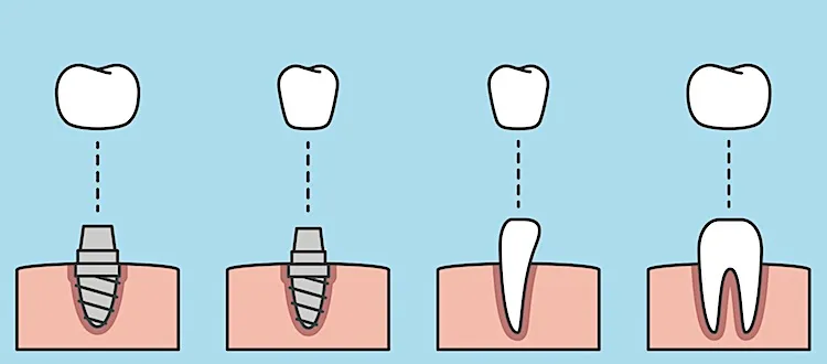 Illustration: Dental Implants and Dental Crowns, showing both crown and root parts
